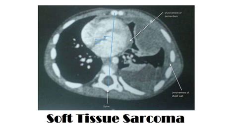 Soft Tissue Sarcoma: 7 Types, Causes, Symptoms, And Diagnosis