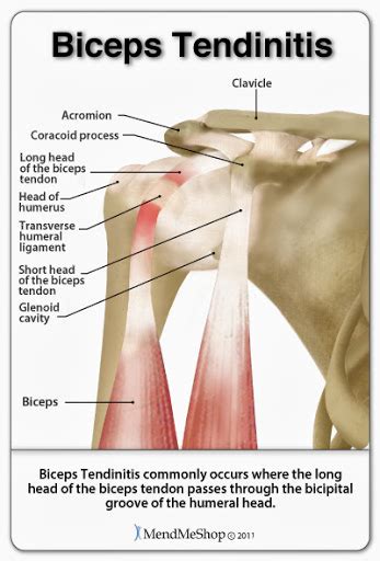 Bicep Tendonitis