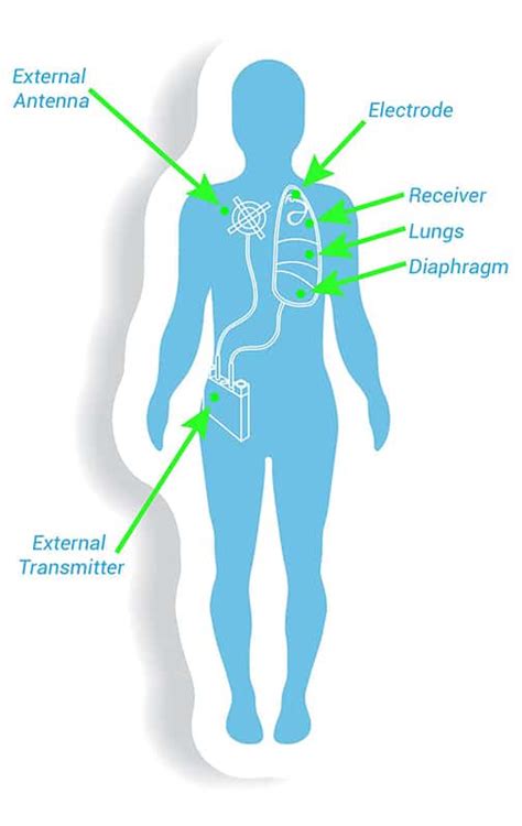 Diaphragm Pacing Explained - Avery Biomedical