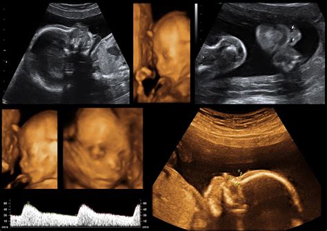 Understanding 2D, 3D and 4D pregnancy ultrasounds - International Ultrasound Services