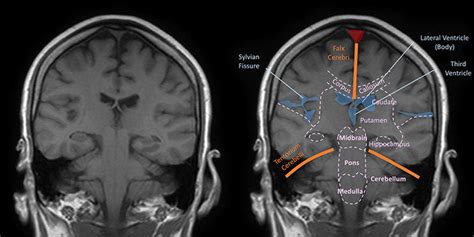 Mri Brain Anatomy