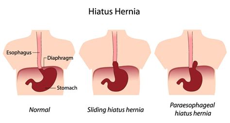 Hiatus Hernia | Jackson Siegelbaum Gastroenterology