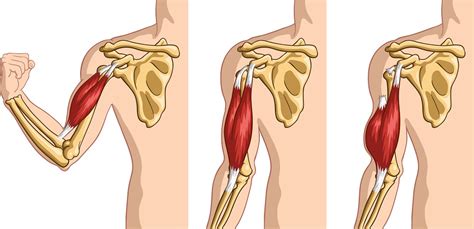 What Causes a Bicep to Tear: How to Prevent and Treatment Options - Power of Prevention (POP)