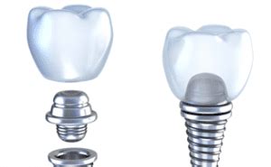 Dental Implants – Recovery Tips that everyone must know - Dental Implants