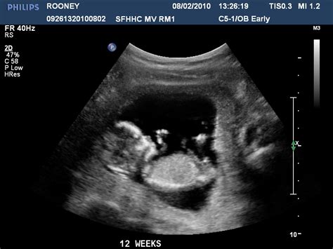 Pregnancy Ultrasound Pictures 12 Weeks