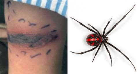 False Black Widow Bite Treatment / How to spot false widow spiders: What to do if the False ...