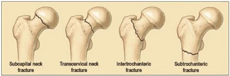 Subcapital Fracture Is Used to Describe