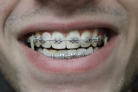 Understand The Difference Between Clear and Metal Braces