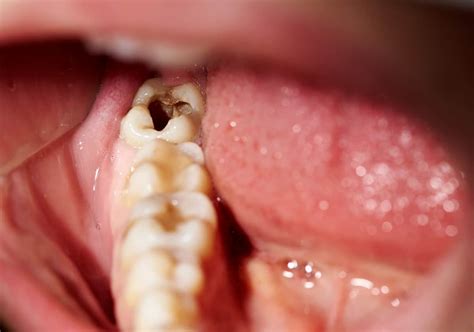 What Causes a Tooth Infection?