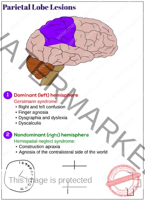 Parietal lobe lesions - Medicine Keys for MRCPs