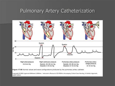 PPT - Pulmonary Artery Catheter PowerPoint Presentation, free download - ID:3211413