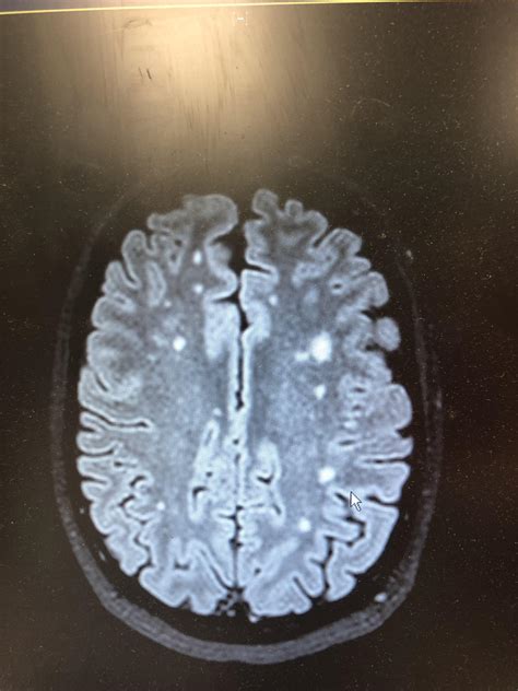 white matter disease mri Mri lesions diffuse axial - Diseases Club center