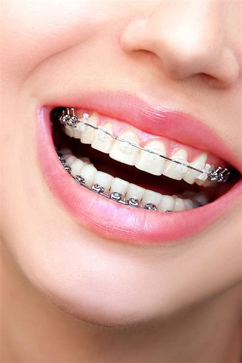 Ceramic Braces | Ceramic braces, Dental braces, Orthodontics