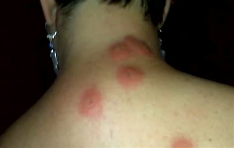 Bed Bug Bites – Pictures, Symptoms, Causes, Treatment | HubPages