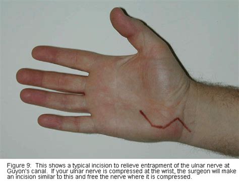 Right Ulnar Nerve Transposition Surgery