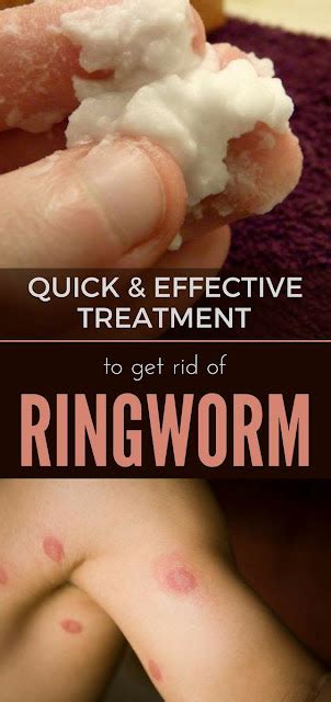 Home Remedies For Ringworm - TOP 5 DIY