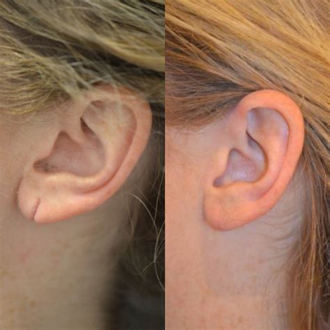 NYC Torn Earlobe Repair | Manhattan Earlobe Plastic Surgery | UES