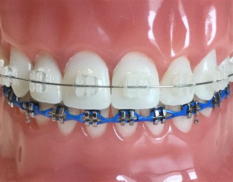 Ceramic Braces vs. Metal Braces - Sherman & Balhoff Orthodontics