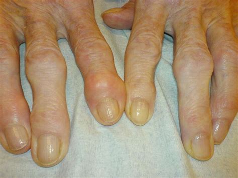 Osteoarthritis: 10 Osteoarthritis Symptoms