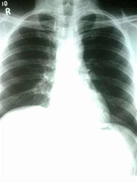 The Diaphragm - Actions - Innervation - TeachMeAnatomy