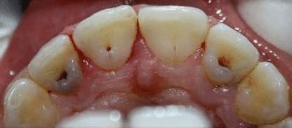 The clinical palatal view shows prominent palatal cingulum with... | Download Scientific Diagram