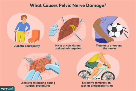 What Causes Pelvic Nerve Pain?