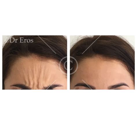 Before and after anti-wrinkle frown lines – Dr Eros Avjioglu