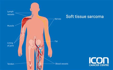 What is Soft Tissue Sarcoma? Soft Tissue Sarcoma Explained — Icon Cancer Centre