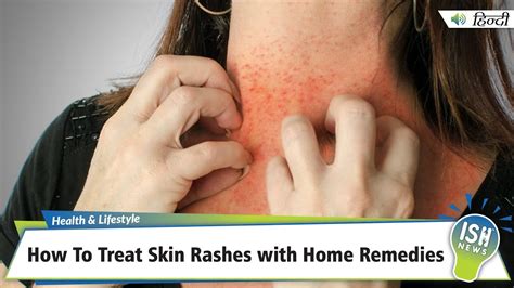 How To Treat Skin Rashes with Home Remedies | ISH News - YouTube