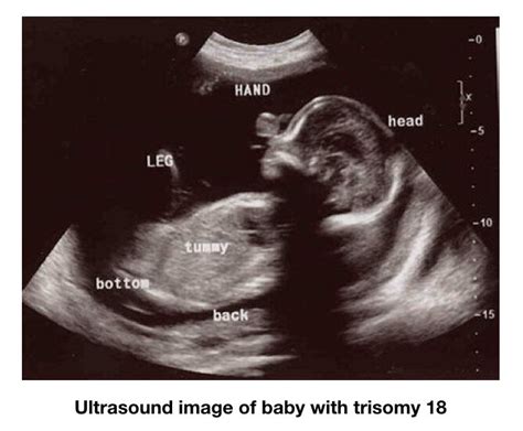 Trisomy 18- Definition, Symptoms, Pictures, Diagnosis And Life Expectancy