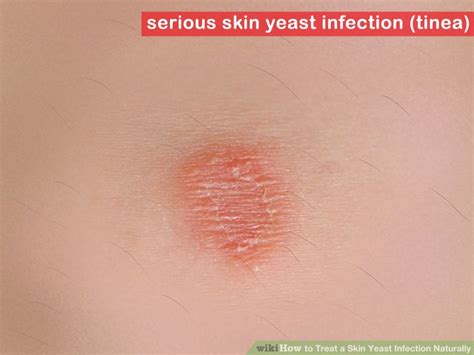 skin yeast infections - pictures, photos