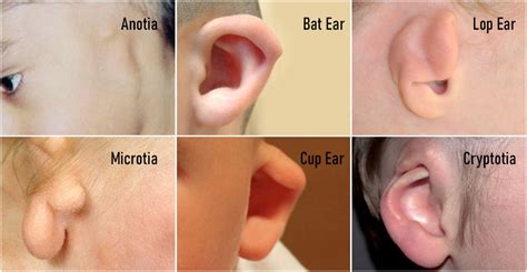 Types of Ear Deformities and Treatments