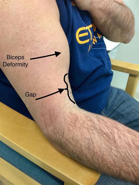 Does A Bicep Tear Require Surgery? – Howard J. Luks, MD