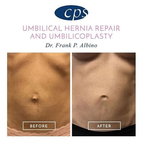 Umbilical Hernia Repair Before And After - ScienceHUB