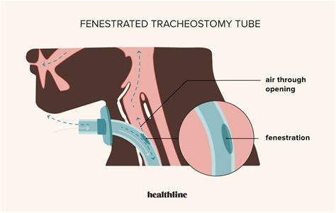 Fenestrated Tracheostomy Tube: Purpose, Uses, and Risks