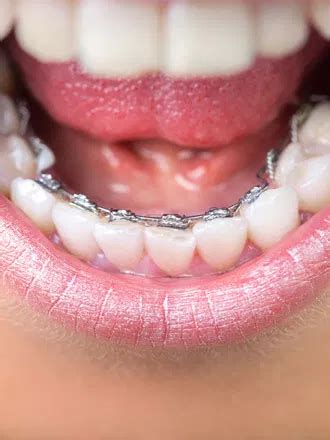 Lingual Braces - Moore Orthodontics | Birmingham AL