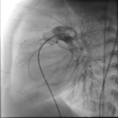 Pulmonary angiography in lateral view. | Download Scientific Diagram