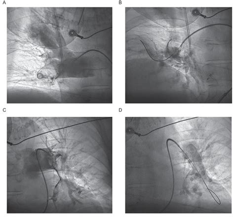 A/B: Pulmonary angiography of the right pulmonary artery before and... | Download Scientific Diagram