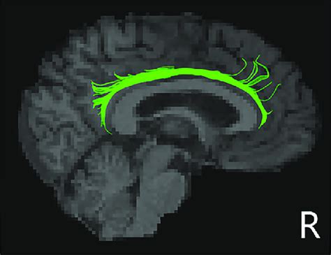 Schematic representations of the decreased right cingulum cingulate... | Download Scientific Diagram