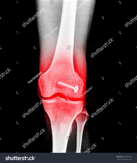 149 Femoral Nail Images, Stock Photos & Vectors | Shutterstock