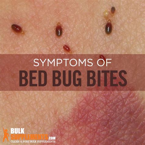 Bed Bug Bites: Characteristics, Causes & Treatment