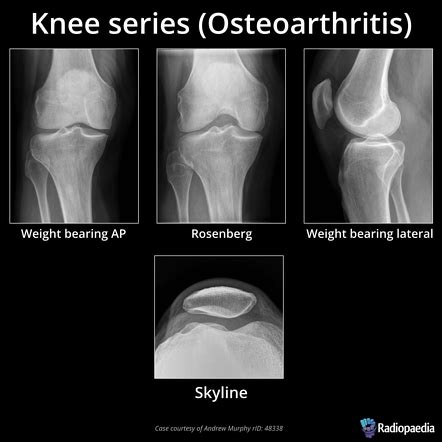 Osteoarthritis Knee