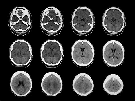 Ct Scan Brain Anatomy : Anatomy Of Head Ct Scan Normal The Brain On Ct And Mri ... / Frontal ...