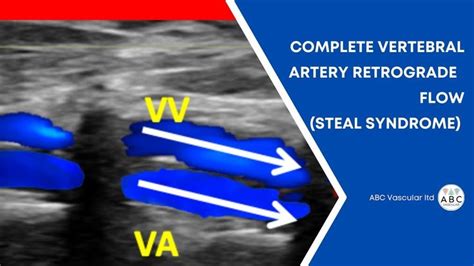 Subclavian Artery, Vertebral Artery, Video Case, Retrograde, Arteries, Ultrasound, Syndrome ...