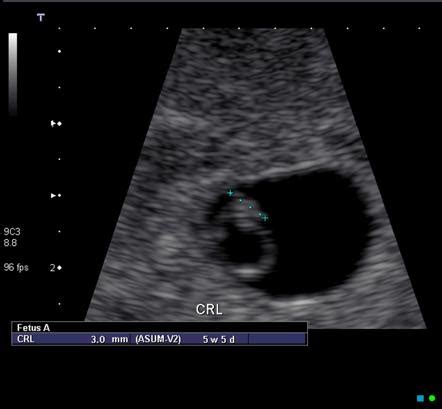 6 Week Transvaginal Ultrasound