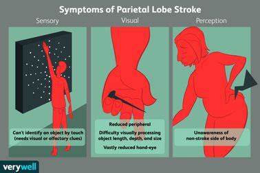 Parietal Lobe Stroke: Signs, Symptoms, and Complications