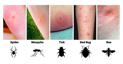 Spider Bite Chart