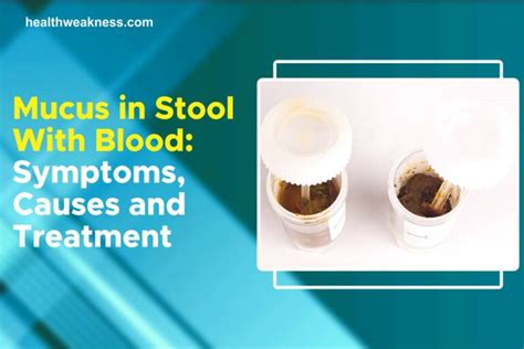 Mucus In Stool With Blood: Symptoms, Causes, Treatment 2023