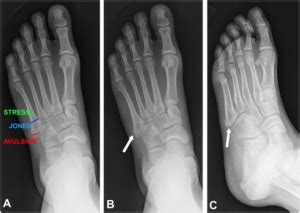 Fifth metatarsal fracture - WikEM