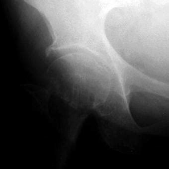 Supine AP X-ray of the right hip joint with a non-displaced subcapital... | Download Scientific ...